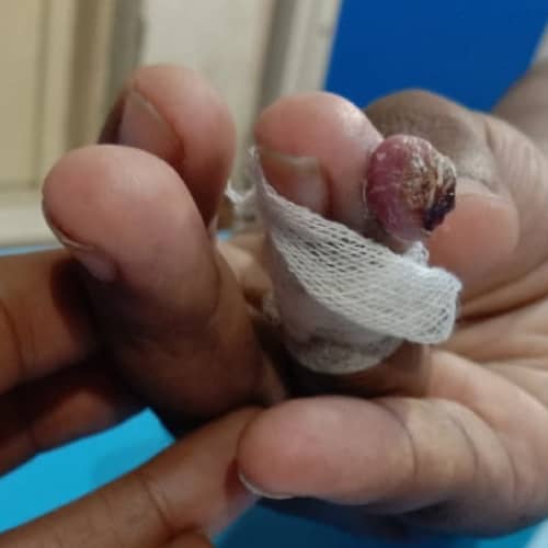 Infected-grannuloma-on-finger