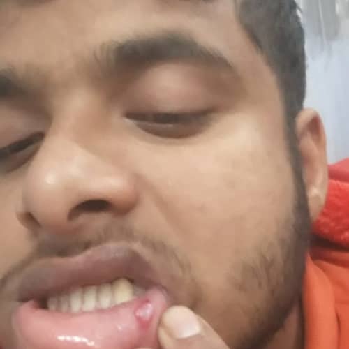 mouth ulcer with cystic swelling