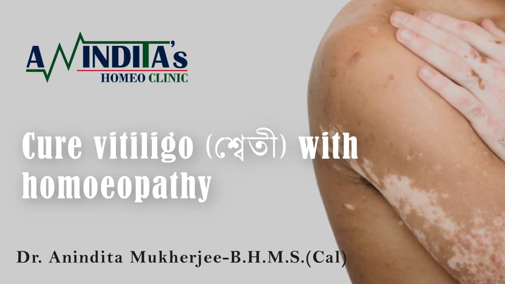 best homeopathy treatment by Dr. Anindita Mukherjee for Vitiligi in kolkata, Belgharia, Barrackpore