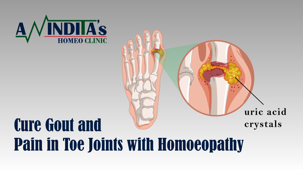 Treat gout and pain in toe joints-By Dr. Anindita Mukherjee (One of the best homoeopathy doctor in Kolkata)