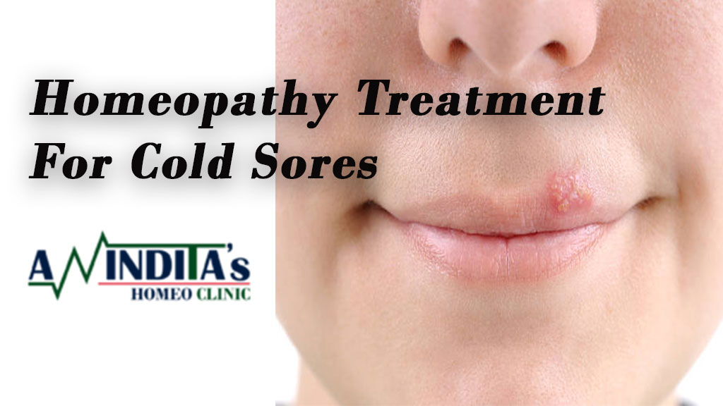 Homoeopathy Treatment for Cold sores in Kolkata – Dr. Anindita Mukherjee (One of the best homeopathy doctor in Kolkata)