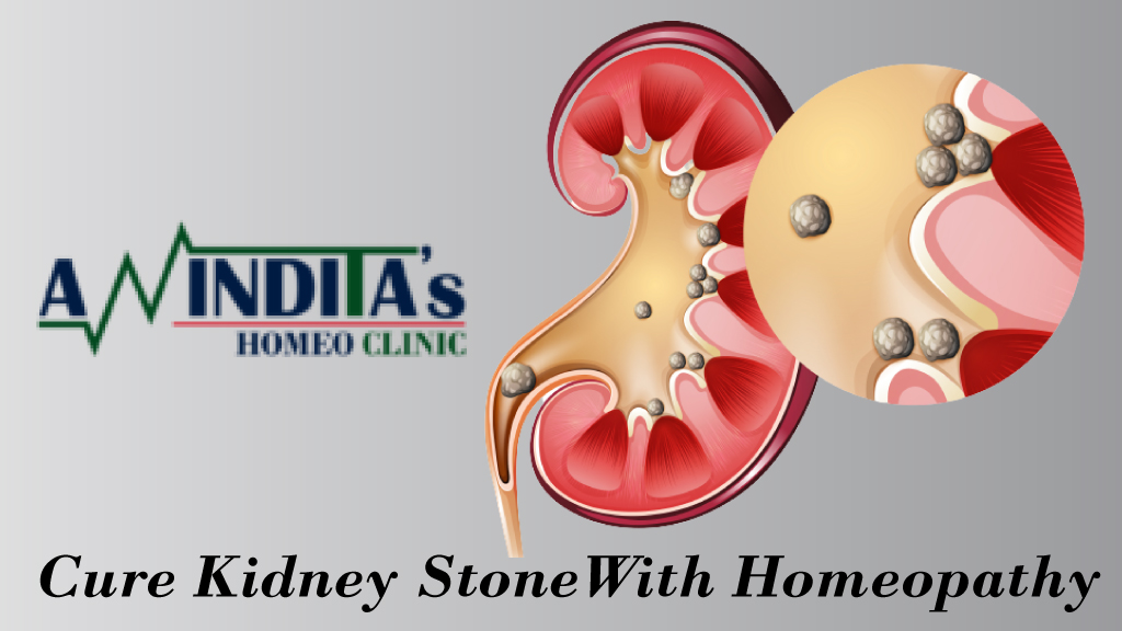 Homeopathy Treatment of Kidney Stones in Kolkata – Dr. Anindita Mukherjee (One of the best homeopathy doctor in Kolkata)